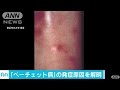 原因不明の ベーチェット病 発症のメカニズム解明 17 02 07 原因不明の ベーチェット病 発症のメカニズム解明 17 02 07