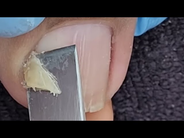Satisfying ingrown toenail removal