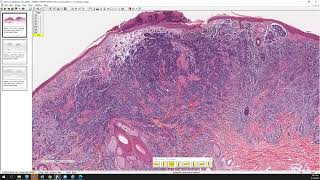 Merkel cell carcinoma screenshot 5