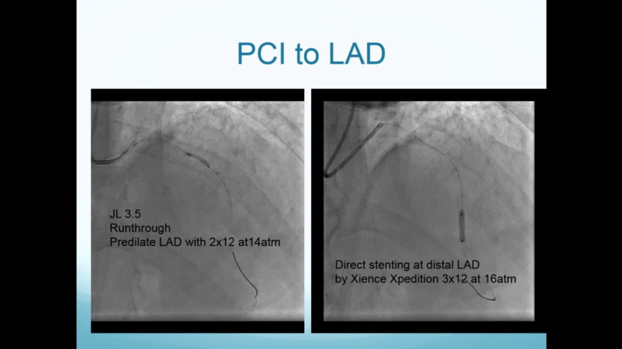 CVI2017 Challenging Case: One, Two and Three - Cheuk Ming Yan, MD interventional cardiology jobs
