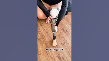 Onder de knie geamputeerde kan geen zuigkracht krijgen uit gat in ophanghuls prothesebeen