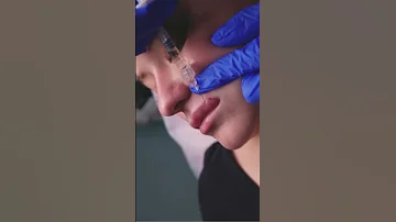 تقنية فيلر الشفايف الروسية مع الدكتورة نائلة الدغمي في الأردن زراعة الاسنان والتجميل 