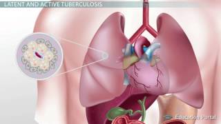 Tuberculosis  Diagnosis, Treatments