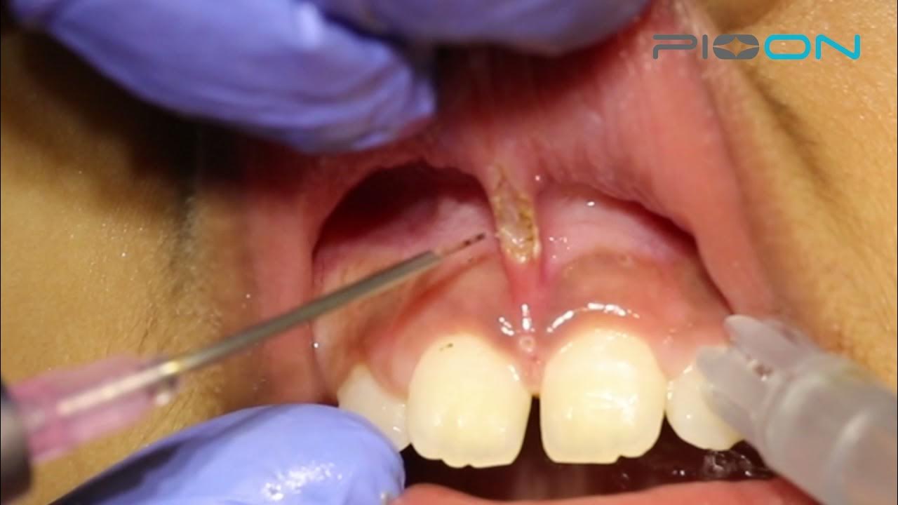 Frenectomy procedure using S1 Pioon laser in Padiatric patient YouTube