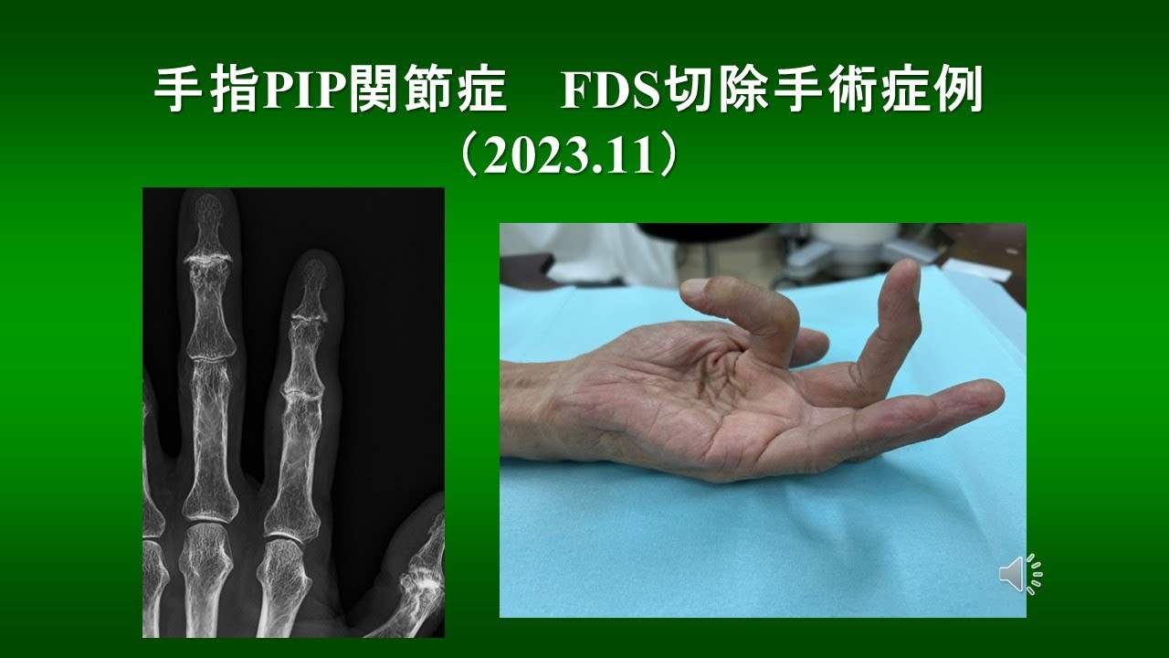 手関節・手指の手術 手指PIP関節症 FDS切除手術症例（2023.11） - YouTube