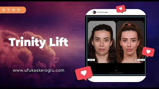 All you need to know about trinity lift @drufukaskeroglu