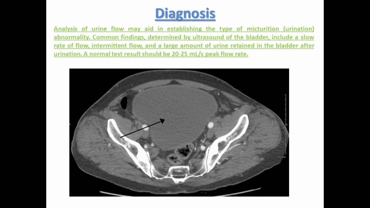 Easy way to solve your Urinary retention