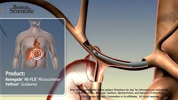FIS - Chemoembolization of Liver Tumor