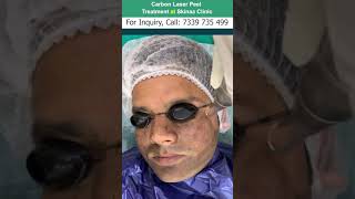 Carbon Laser Peel Treatment At Skinaa Clinic Viral 