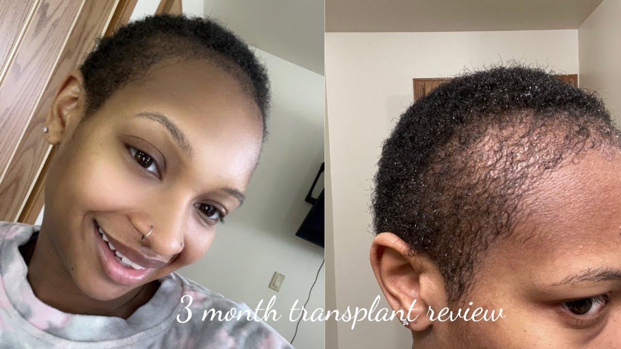 3 Month hair transplant review | WOULD I GO BACK TO LONGEVITA???