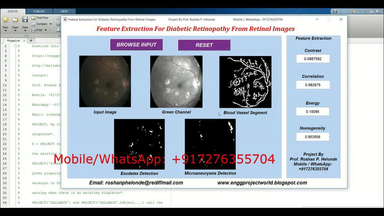 Feature Extraction For Diabetic Retinopathy From Retinal Images Matlab ...