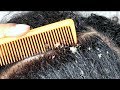 Lots of FLAKES! Satisfying Scalp scratching and picking ASMR Dandruff flakes REMOVAL