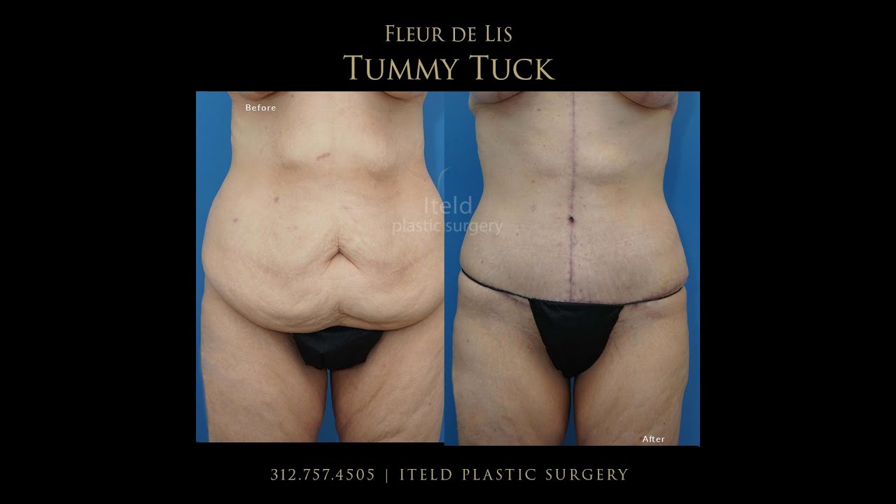 Fleur De Lis Tummy Tuck Tattoo Ideas Fleur De Lis Tummy Tuck Tattoo Ideas