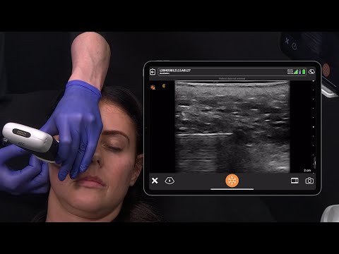 Image of Cheek Injections