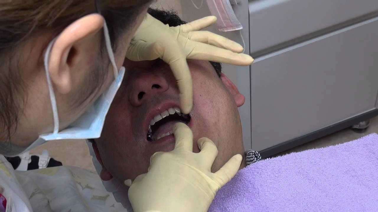 茨城県水戸市フカヤ歯科ポリリンホワイトニング体験男性2