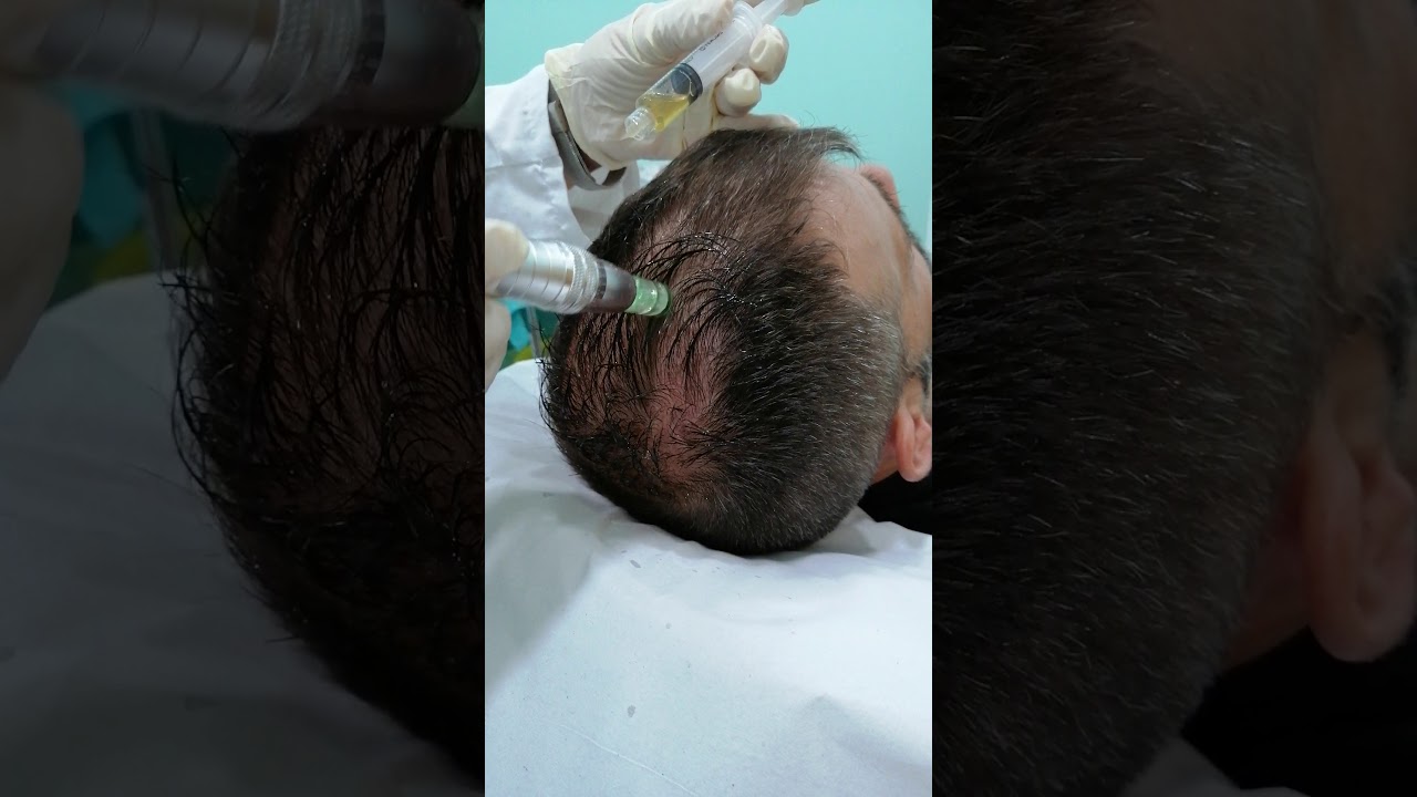 Tratamiento PRP Capilar