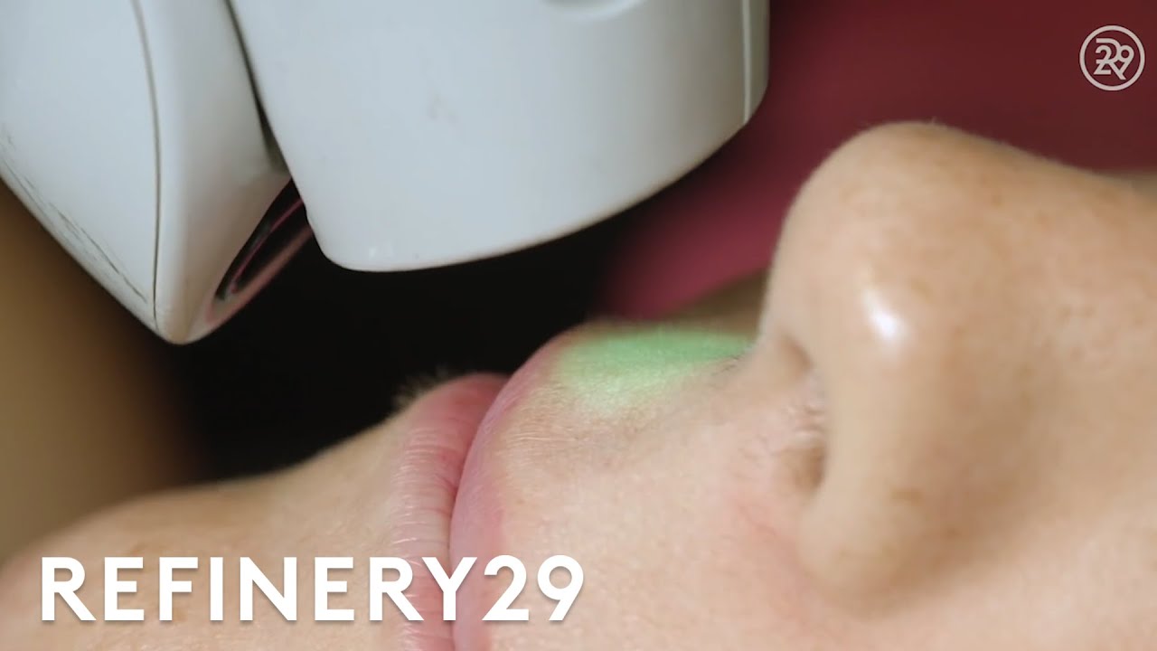 I Got Facial Laser Hair Removal For The First Time | Macro Beauty | Refinery29