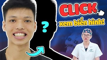 4 Ca Răng Hô Trước Và Sau: Ngỡ Ngàng Với "Trùm Cuối"| Nha Khoa Lạc Việt Intech