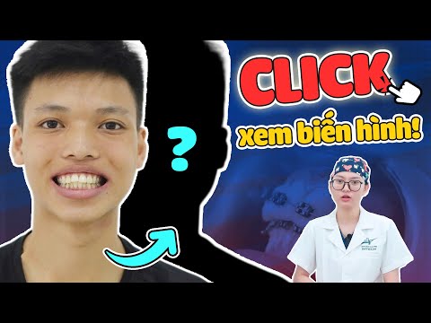 4 Ca Răng Hô Trước Và Sau: Ngỡ Ngàng Với "Trùm Cuối"| Nha Khoa Lạc Việt Intech