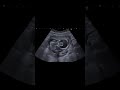 Holoprosencephaly | Brain anomaly |Ventriculomegaly Anomaly Scan | fetaldefect pregnancy | Radiology