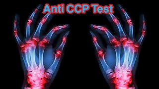 What does anti-CCP positive mean | What is anti-CCP normal range | Anti CCP Test