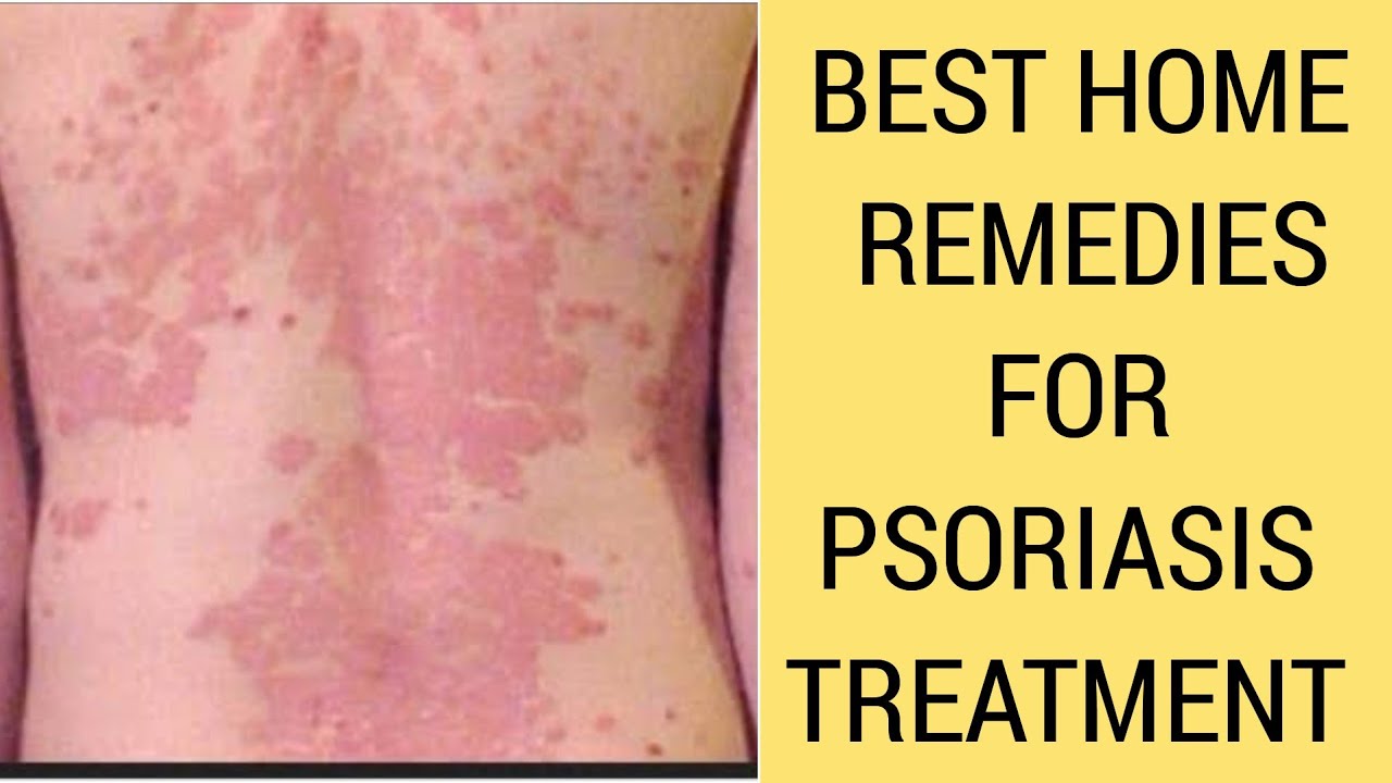 Best Home Remedies For Psoriasis Treatment Healthy Life Youtube