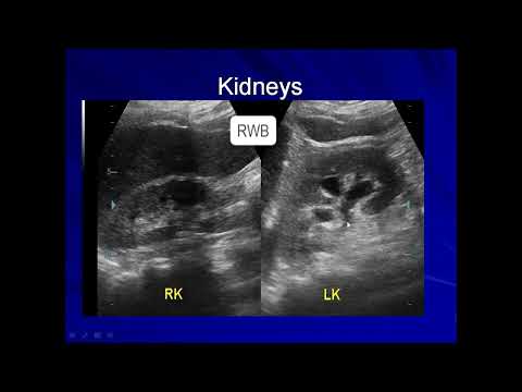 Ultrasound Features of Transitional Cell Carcinoma/ Urothelial Carcinoma of the Urinary Bladder