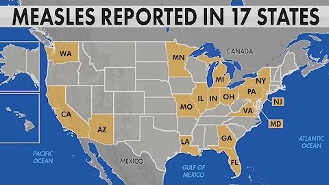 Measle cases in the U.S. on the rise