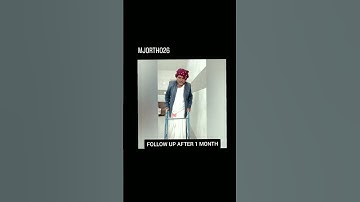 Distal Tibia Non-union with Broken Implant