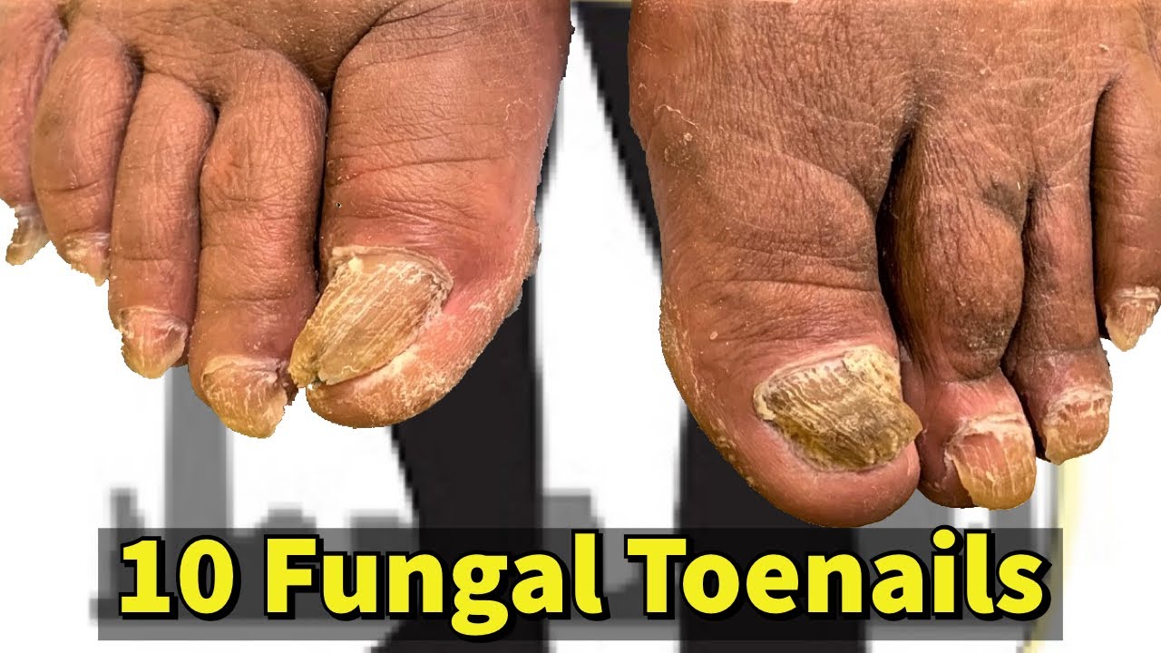 Treatment In London For Nail Disorders & Fungi