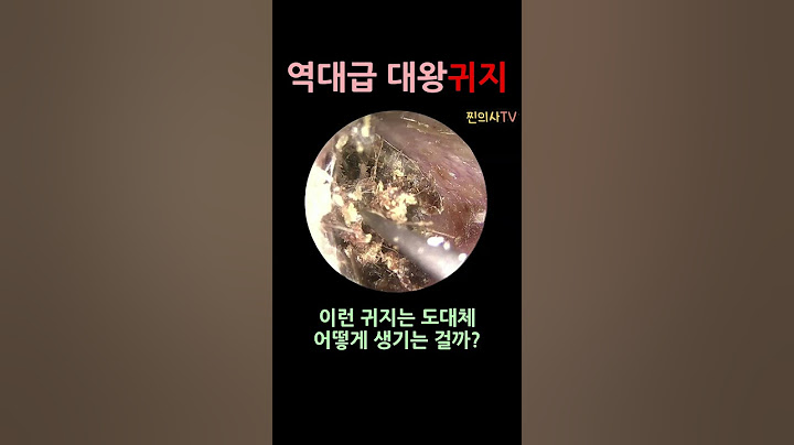 역대급 대왕 귀지제거 영상 #shorts