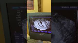 What an 11 Week Ultrasound Looks Like!