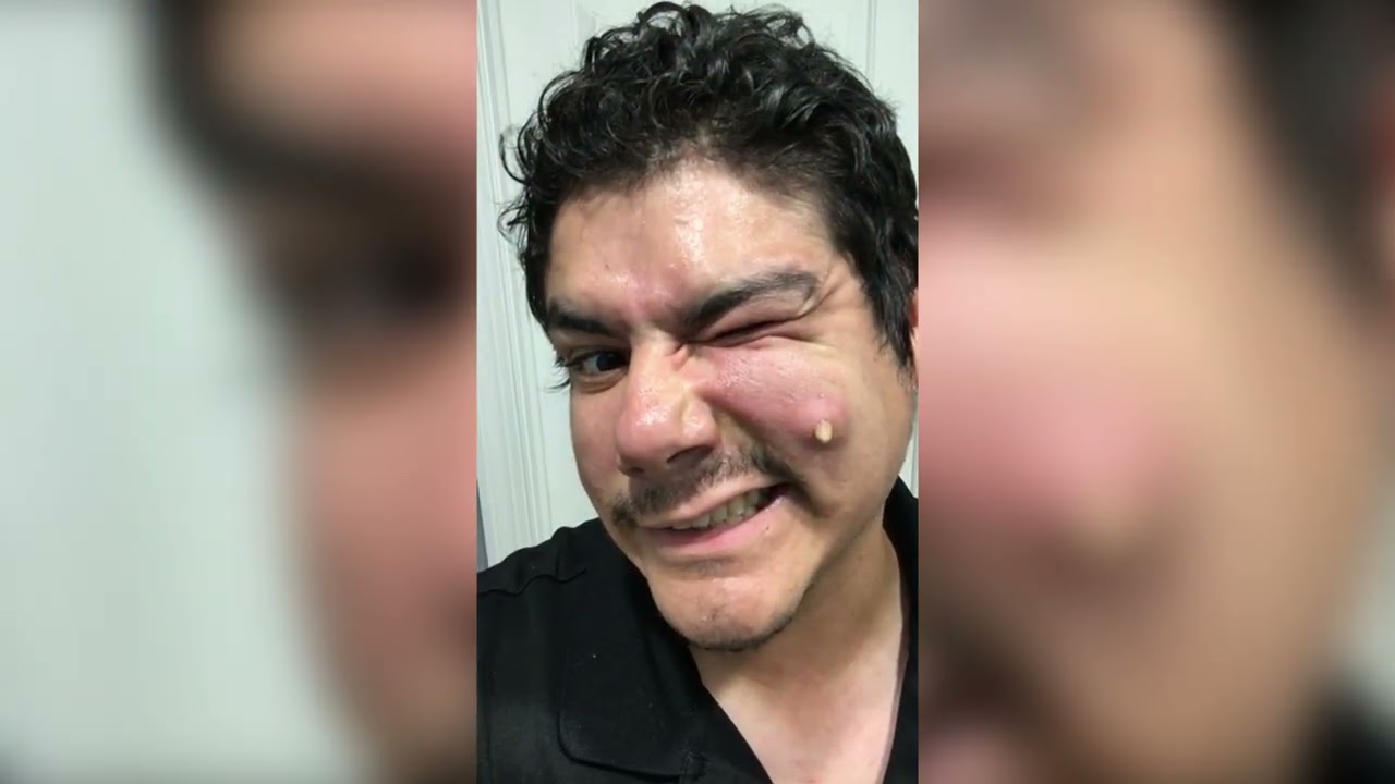 Popping huge blackheads and Pimple Popping - Best Pimple Popping Videos #8
