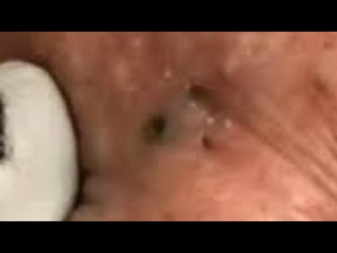 Blackheads and Acne