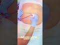 lost inches in 2 hours ❤️❤🔥 #lipocavitation #bodyshaping #fatloss #bodysculpting #healthylifestyle