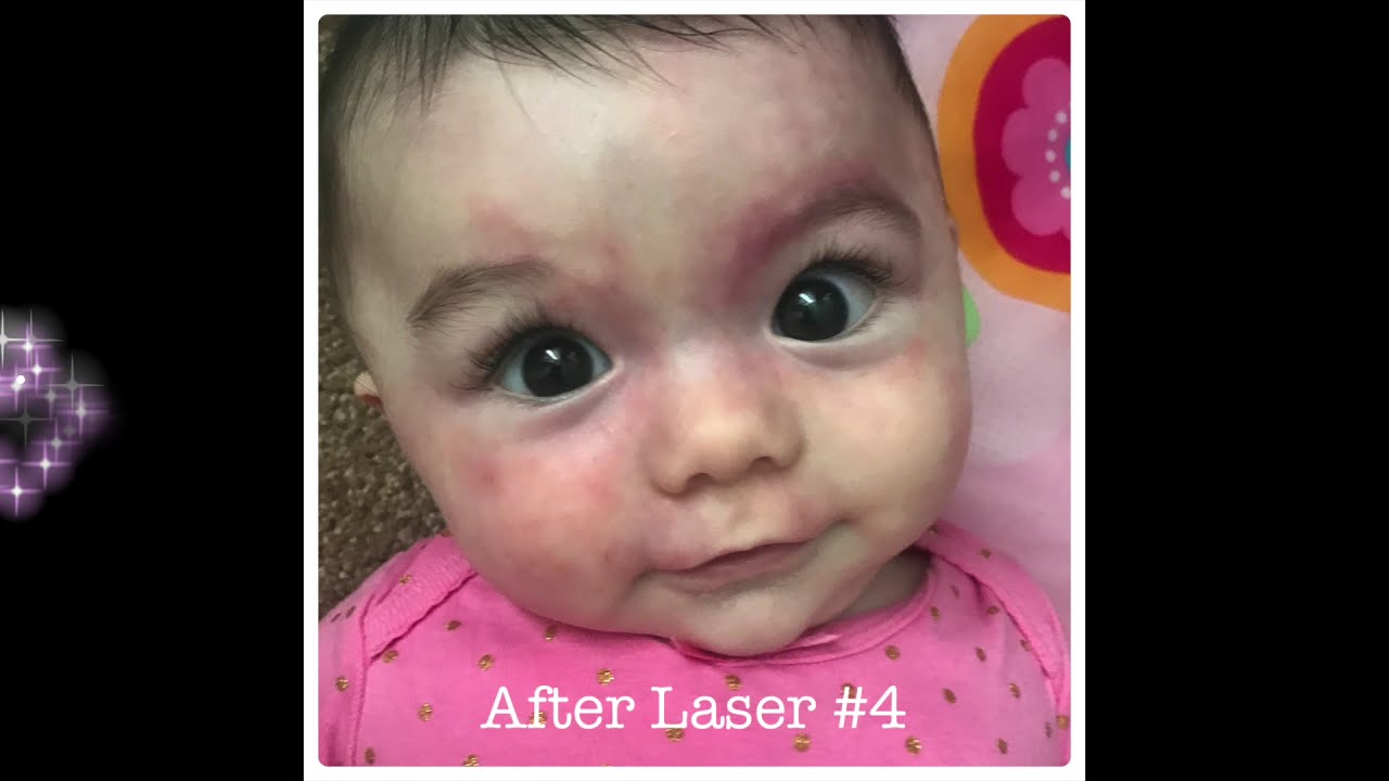 Tiny But Mighty Bink - Pulsed Dye Laser Progression 2018