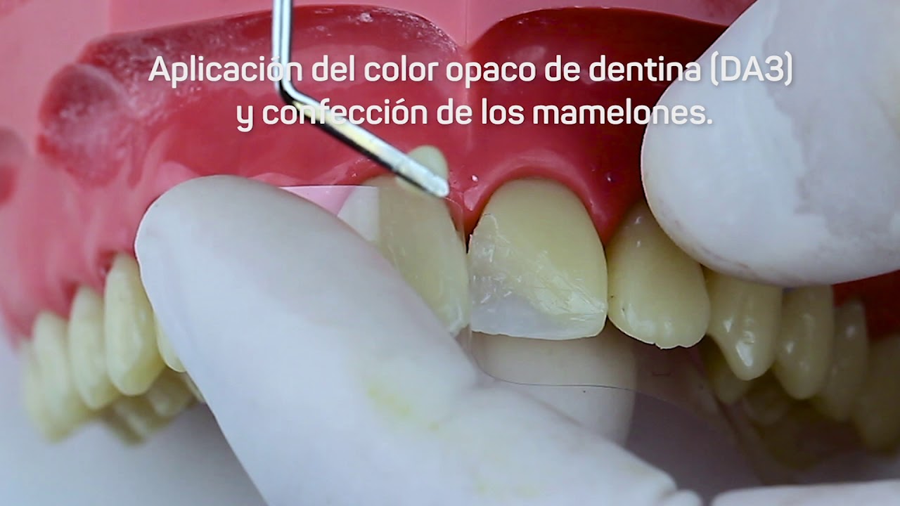 [ESP] Restauración clase IV con Vittra APS