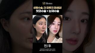 성품성형외과 눈코수술 후기 #코수술 #코수술후기 #쌍꺼풀수술 #강남성형외과 #성품성형외과 #성형후기 #sungpum
