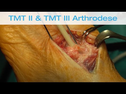 TMT II und TMT III Arthrodese mit humaner Knochenschraube Shark Screw®