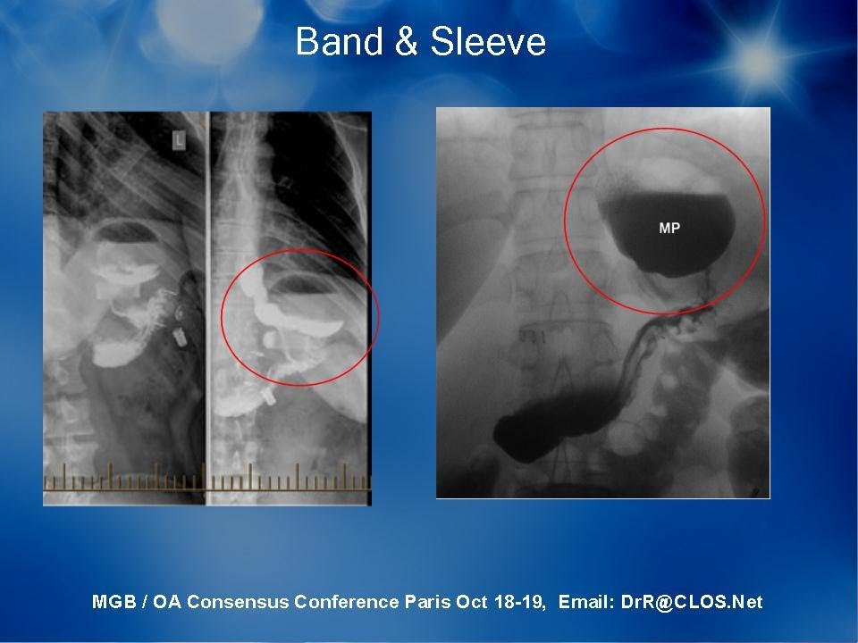 Acid Reflux Leads To Esophageal Cancer; Both Sleeve &amp; Band ...