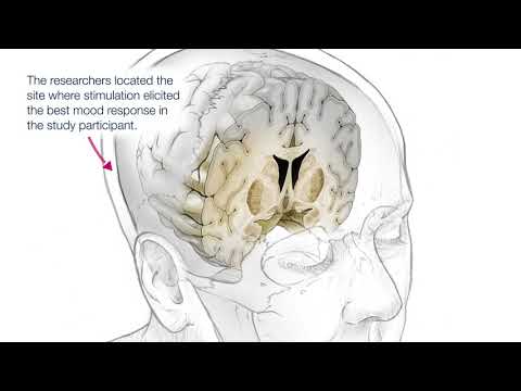 Personalized Deep Brain Stimulation Therapy (DBS)