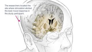 Personalized Deep Brain Stimulation Therapy (DBS)