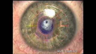 Keratoconus Correction: Gulani Keratoconus Surgeries: Think Beyond the "CONE"