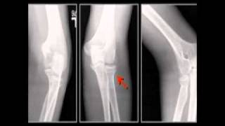 LearningRadiology 57 (Elbow Fractures-Dislocations)