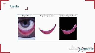 AI method to screen anemia using smart phone screenshot 4