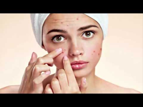 What are the REAL causes of Cystic Acne, Pimples And Blackheads ?