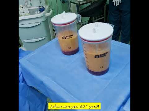 شفط وشد الفخذين جراحيا بعد فقدان وزن كبير جدا