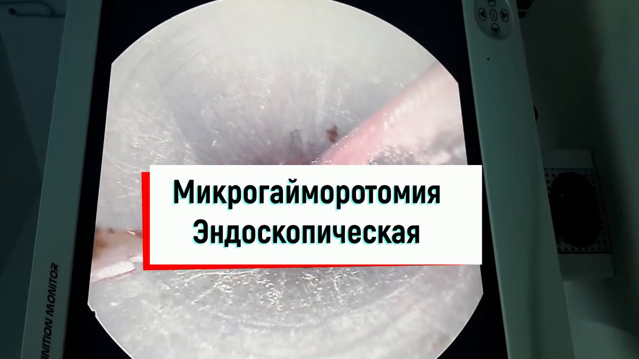 Киста. Полипы. Эндоскопическое удаление кисты и полипозной ткани из гайморовой пазухи.FESS