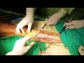 Lower Limb Fasciotomy Procedure