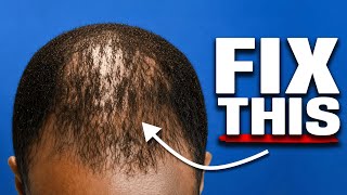 how I STOP hair loss as a Black Man ( FULL routine)